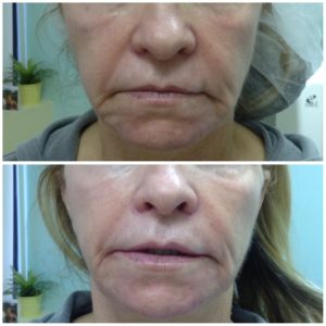 Juvederm Filler Dunkirk Aesthetics